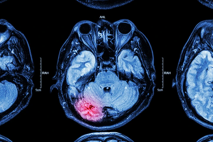 Brain Injury Law in San Jose