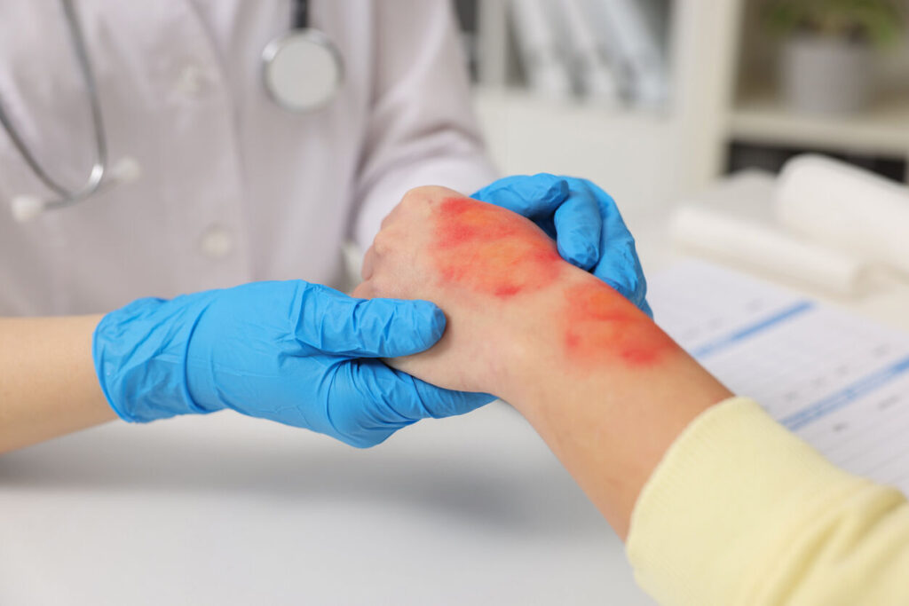 San Jose Burn Injury Lawyer